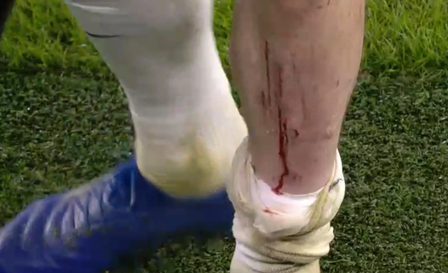 Bài ảnh chấn thương rùng rợn của Pierre-Emile Hojbjerg - Bóng Đá