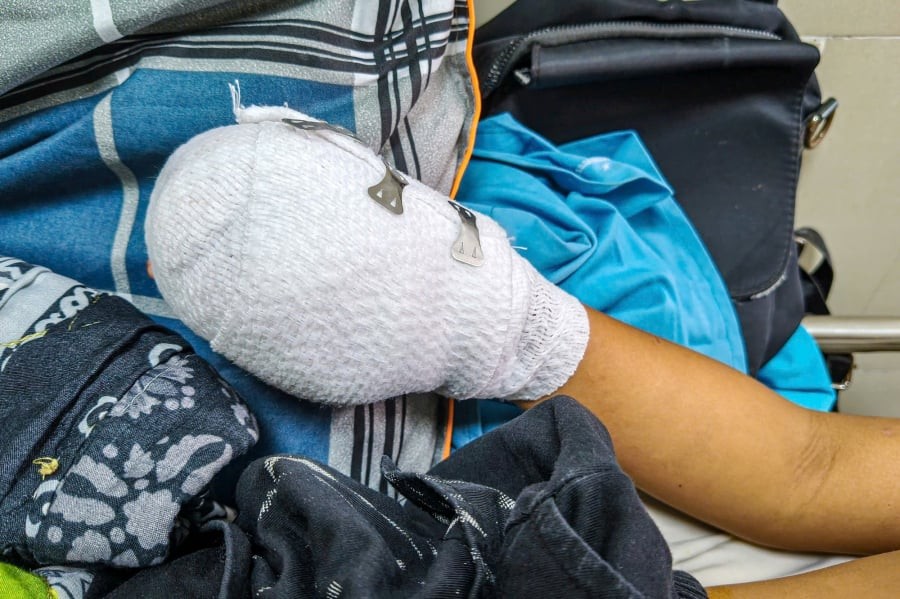 Ngay sau khi tiếp nhận, ê-kíp bác sĩ đã khẩn trương tiến hành phẫu thuật xử lý vết thương, cầm máu và bảo tồn tối đa chức năng bàn tay cho bệnh nhi. 