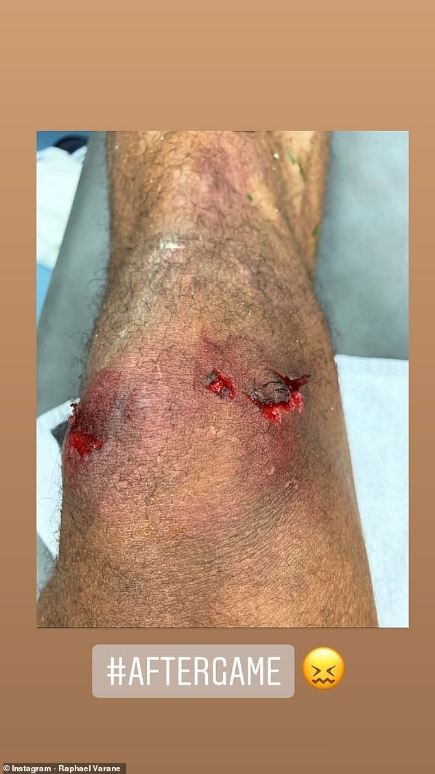 Varane chấn thương - Bóng Đá