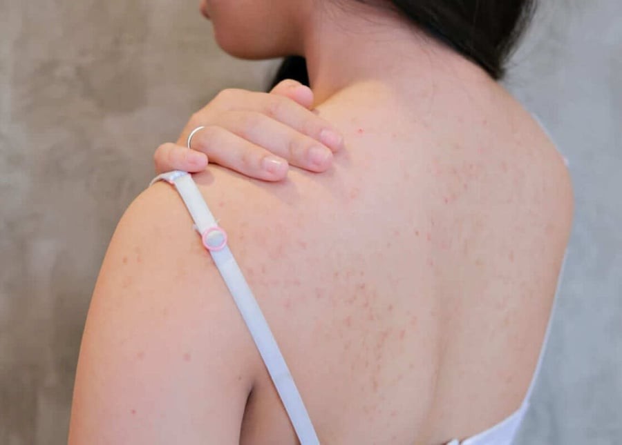 Da body, đặc biệt là vùng lưng, ngực và cánh tay, thường xuyên phải đối mặt với mồ hôi, dầu thừa và ma sát từ quần áo.