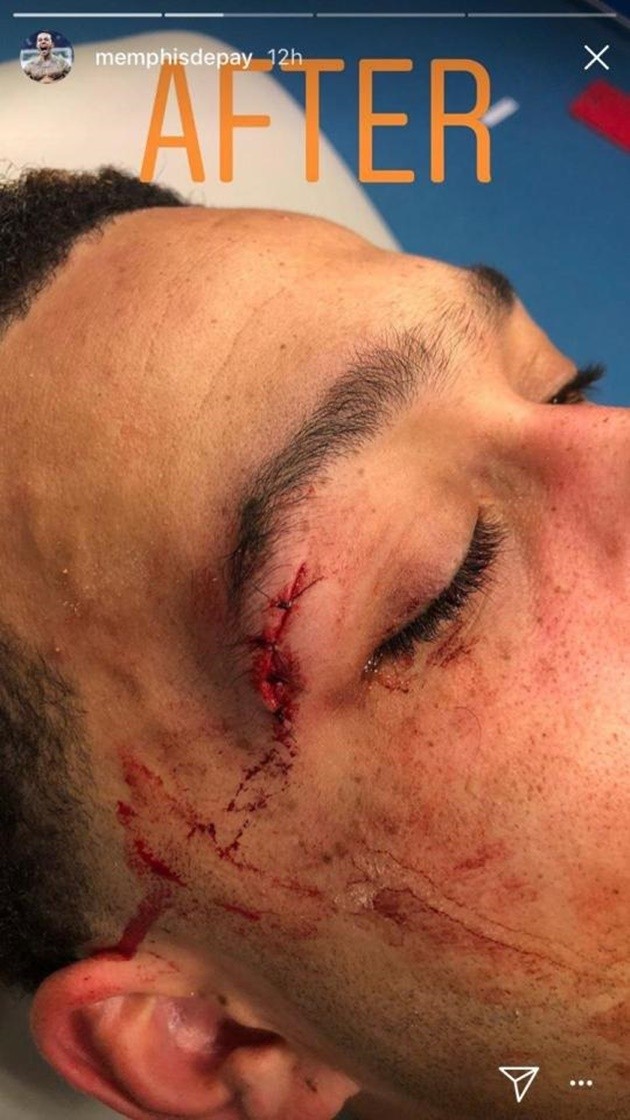 Đã rõ tình hình sức khỏe của Memphis Depay - Bóng Đá