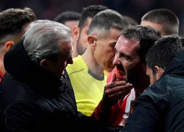Đối phương giật cùi chỏ, sao Atletico Madrid gãy 3 răng cửa - Bóng Đá