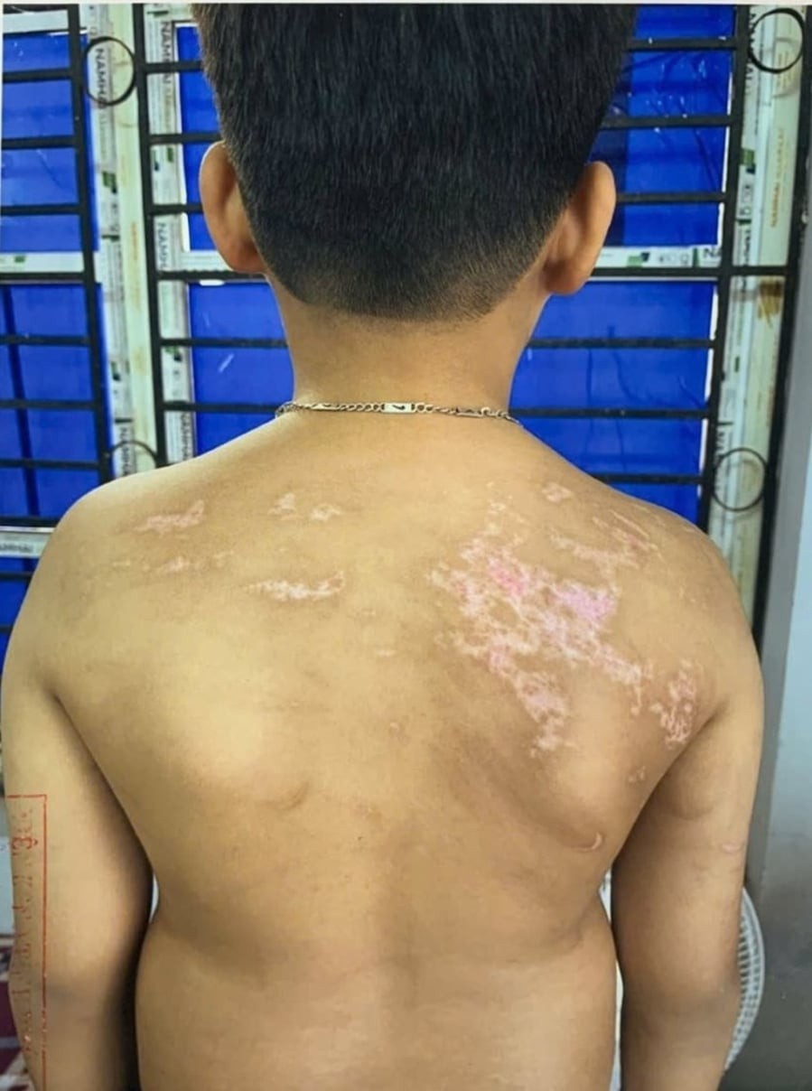 Sau sự việc, Chung phát hiện các vết thương trên cơ thể con nhưng chỉ dùng tinh dầu xịt lên vết thương rồi để cháu đi ngủ. Vụ việc sau đó được cơ quan chức năng vào cuộc điều tra, xử lý theo quy định pháp luật.

