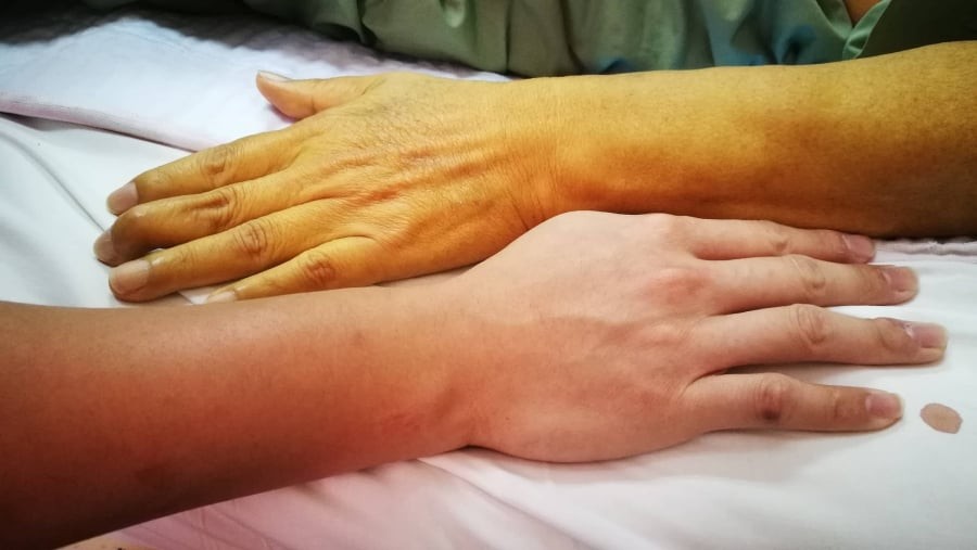 5 dấu hiệu cảnh báo gan thận đang 