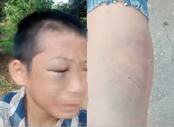 Ngày 13/5, mạng xã hội lan truyền đoạn clip dài hơn 4 phút ghi lại hình ảnh bé trai N.H.Th. (học lớp 6, trú tại xã Vân Du, Nghệ An) với nhiều vết bầm tím, sưng ở vùng mắt và các dấu hiệu nghi bị đánh đập trên cơ thể.