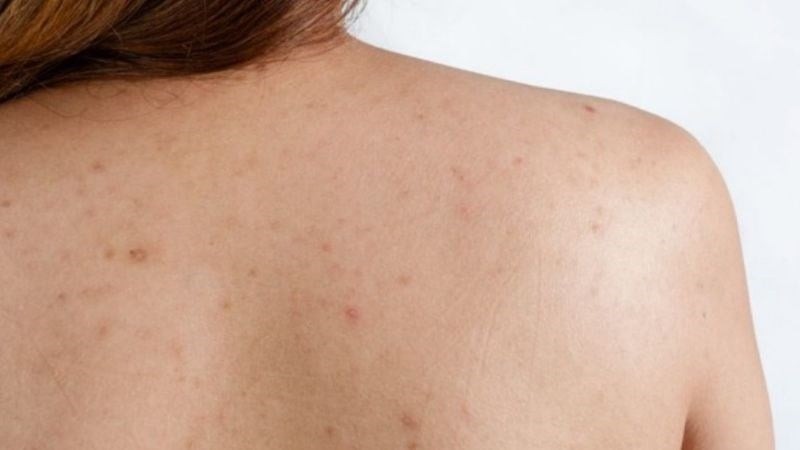 So với da mặt, vùng lưng thường ít được chú ý hơn trong quá trình chăm sóc hằng ngày. 