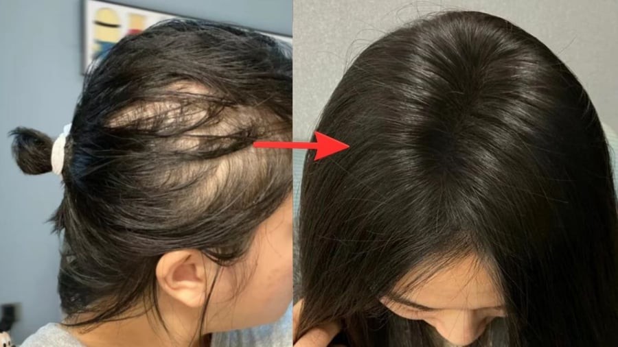 Nuôi dưỡng da đầu là một trong những bước quan trọng để cải thiện tình trạng rụng tóc, kích thích mọc tóc.