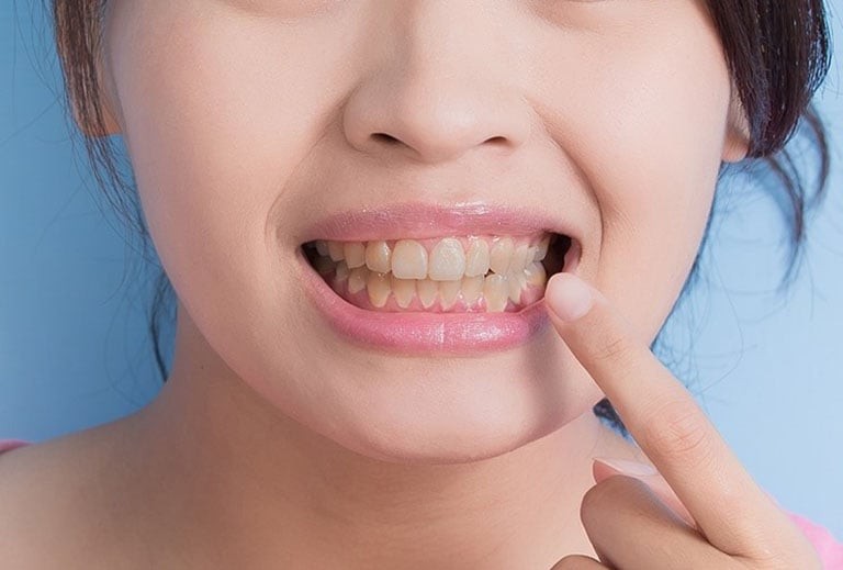 Khi sử dụng liên tục trong thời gian dài, các sắc tố này sẽ tích tụ và khiến răng chuyển sang màu vàng hoặc nâu nhạt.