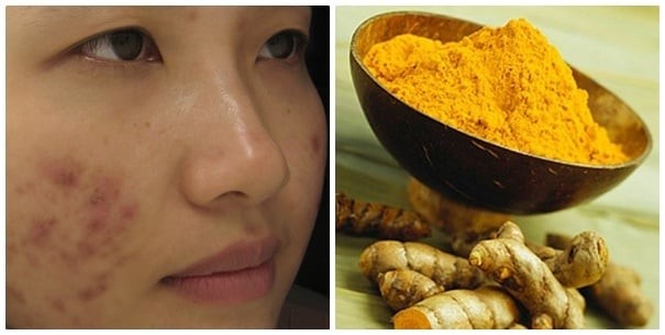 Kiên trì thực hiện 2 – 3 lần mỗi tuần sẽ giúp vùng da sẹo sáng màu và đều màu hơn.

