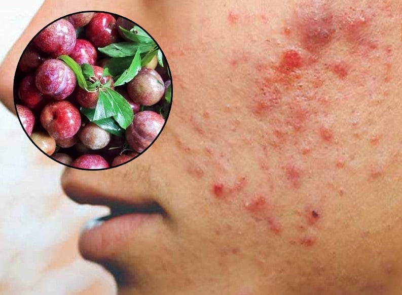 3 đối tượng không được ăn mận: Dễ nổi mụn, nóng trong