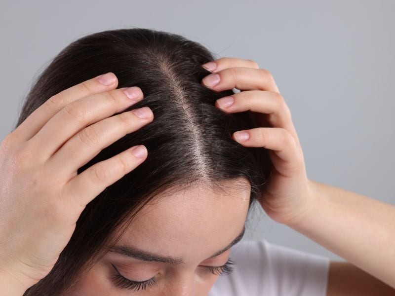 Một số bệnh da liễu như viêm da tiết bã, vảy nến, chàm hay nhiễm nấm Malassezia có thể khiến tế bào da đầu bong tróc