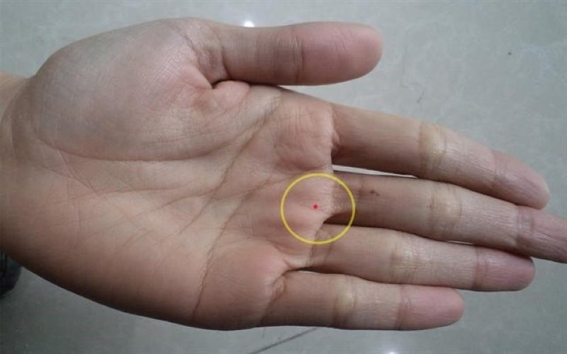 Nốt ruồi mang tới may mắn