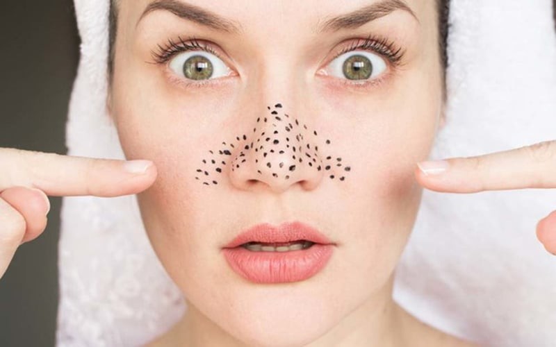  Khi dầu thừa, tế bào chết và mỹ phẩm tích tụ trong nang lông, mụn đầu đen sẽ dễ hình thành hơn.