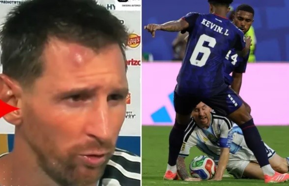 Messi bị sưng ở trán sau pha va chạm với đối thủ. Ảnh: The Sun.