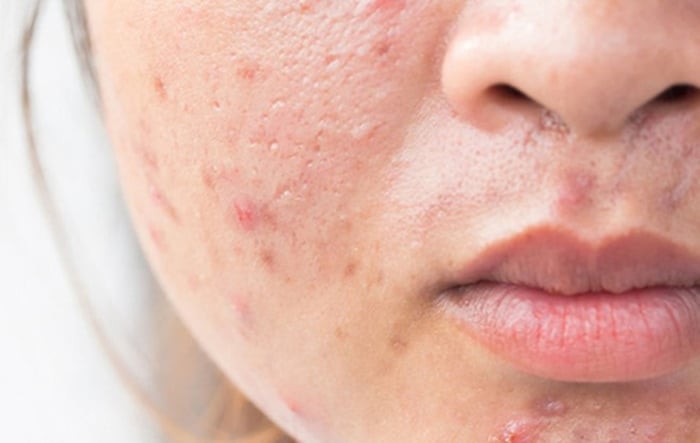  Với khả năng tan trong dầu, BHA có thể đi sâu vào lỗ chân lông để loại bỏ dầu thừa và tế bào chết tích tụ, từ đó giúp giảm nguy cơ bít tắc và hạn chế hình thành mụn mới.