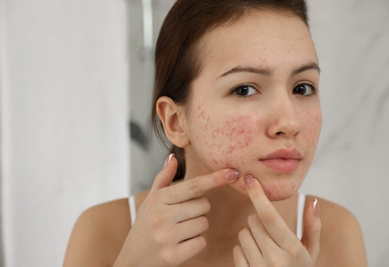 Việc duy trì độ ẩm sẽ giúp da cân bằng tốt hơn trong quá trình sử dụng hoạt chất điều trị.