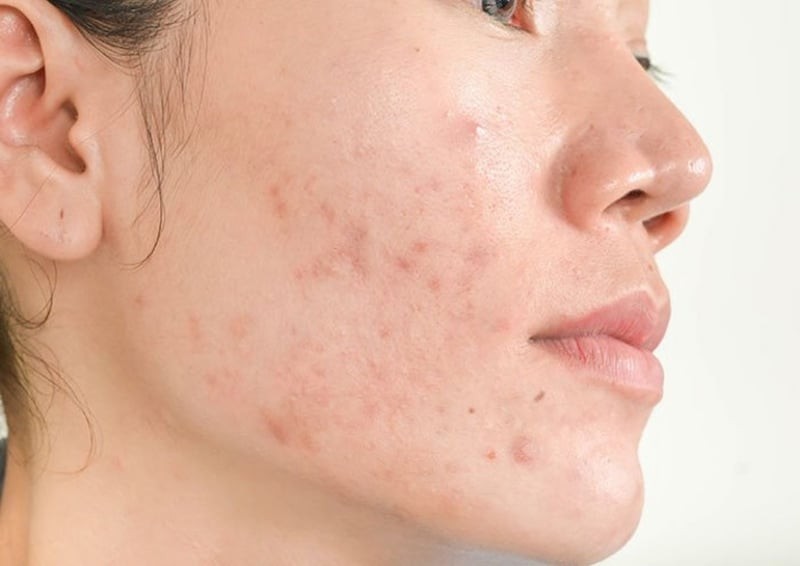 Các dẫn xuất vitamin A như adapalene được đánh giá cao trong việc ngăn ngừa mụn tái phát