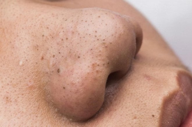 Việc thoa quá nhiều serum, kem dưỡng hoặc các sản phẩm đặc trị trong cùng một quy trình có thể khiến da bị quá tải, làm tăng nguy cơ bít tắc lỗ chân lông.