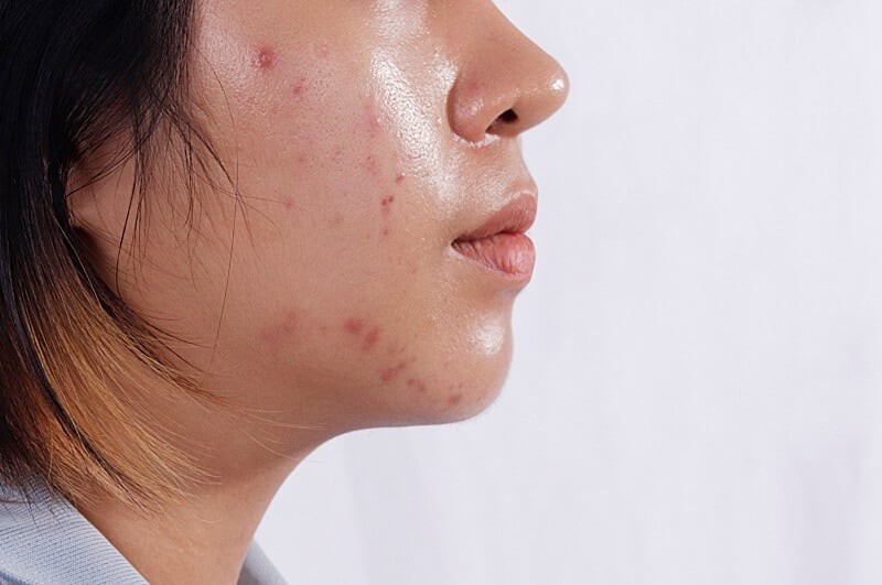 Đặc biệt, việc tự ý nặn mụn bằng tay không chỉ khiến vi khuẩn lan rộng mà còn làm tổn thương da, tăng nguy cơ để lại thâm và sẹo sau mụn.

