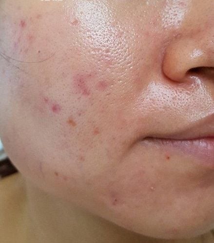 Làm sạch là bước nền tảng trong quá trình chăm sóc da dầu. 