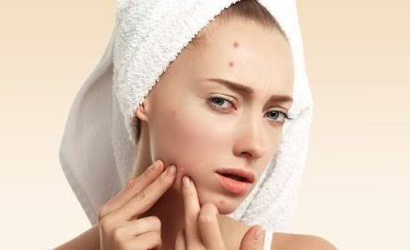Nhiều người có thói quen tự xử lý mụn ngay khi thấy xuất hiện nhân trắng hoặc cồi mụn. 