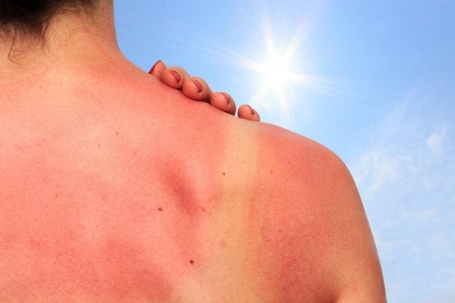 Khi nhận thấy da nóng ran, đỏ ửng hoặc có cảm giác đau khi chạm vào, điều đầu tiên cần làm là nhanh chóng tránh khỏi ánh nắng. 