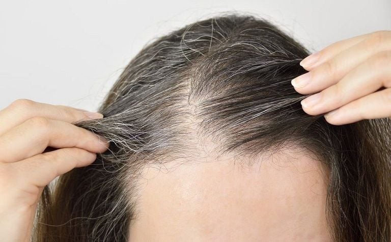 Tuổi tác là nguyên nhân phổ biến khiến hoạt động sản xuất melanin trong nang tóc giảm dần. 