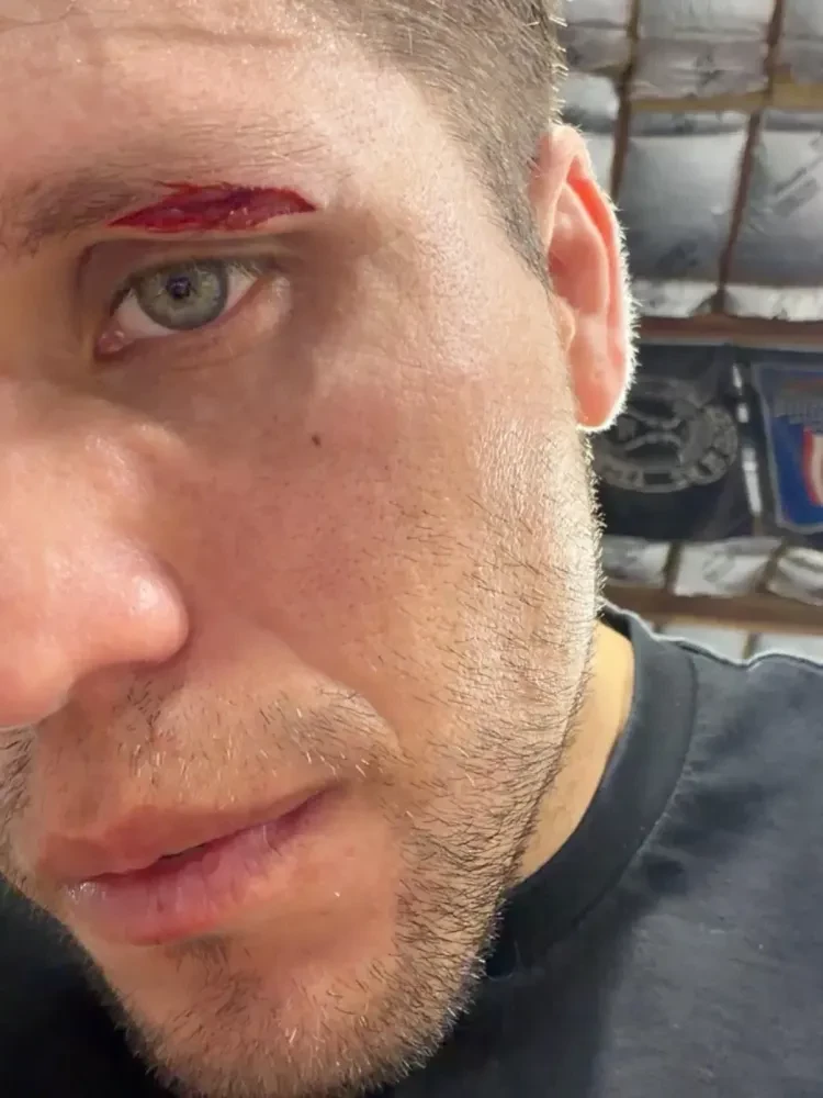 Brian Ortega chấn thương