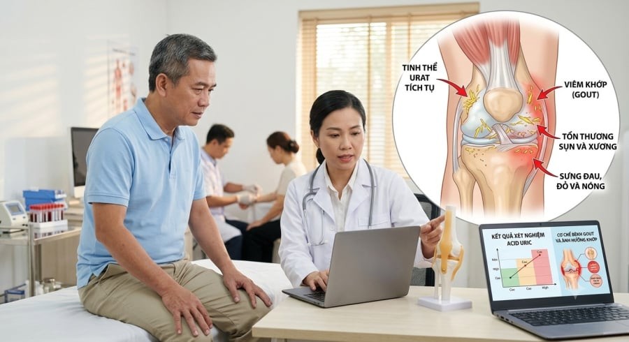 Acid uric tăng có thể diễn tiến âm thầm và không phải lúc nào cũng gây ra cơn gout điển hình.