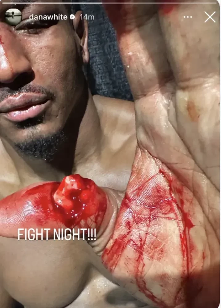 Chấn thương ngón tay cái rùng rợn của Alonzo Menifield tại UFC 331