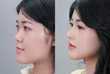 “Xóa mũi tẹt cho thanh thiếu niên Việt”: Hàng loạt bạn trẻ tự tin hơn sau nâng mũi sụn sườn J-Cos