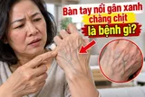 Bàn tay nổi gân xanh chằng chịt là bệnh gì?