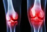 Xuất hiện phương pháp giúp mở thêm hy vọng cho người đau khớp gối