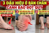 3 dấu hiệu ở bàn chân cảnh báo đột quỵ, số 1 cảnh báo cao
