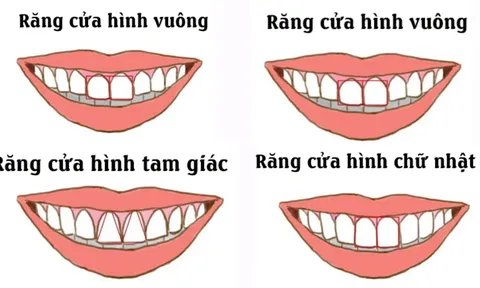 Nhìn tướng răng cửa dự đoán vận số: Tướng răng nào may mắn nhất?