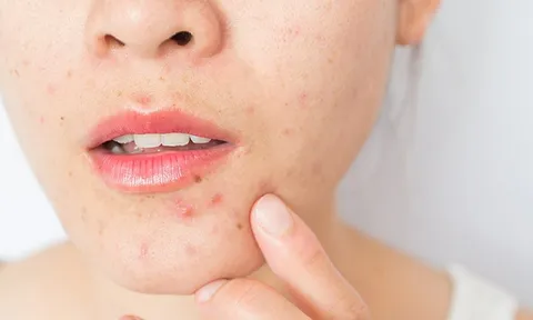 Mụn viêm và cẩm nang điều trị đơn giản tại nhà nàng nào cũng nên biết