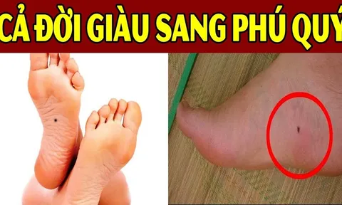 Nốt ruồi Thần Tài đánh dấu, giữ lại là phúc, xóa là mất lộc: Quanh bạn ai có không?