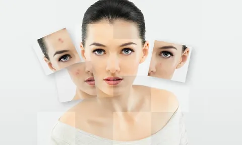 Bật mí giải pháp cứu nguy" khi có nốt mụn xuất hiện đột ngột để nàng xinh tươi hơn ngày 8/3