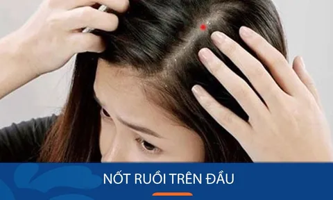 4 nốt ruồi vượng quý nhân, hậu vận giàu có vượt bậc