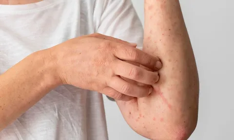 8 dấu hiệu cảnh báo bạn đang mắc bệnh thận giai đoạn nặng: Có 1 cũng nên đi khám gấp