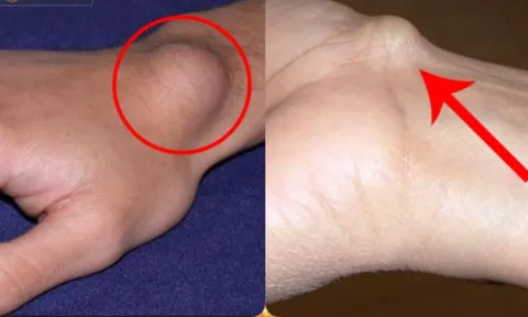 Sáng sớm thấy 4 dấu hiệu này là tế bào K đang tấn công, ăn mòn cơ thể