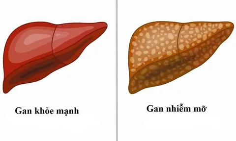 Gan nhiễm mỡ có gây ung thư gan? Chuyên gia cảnh báo dấu hiệu cần biết sớm