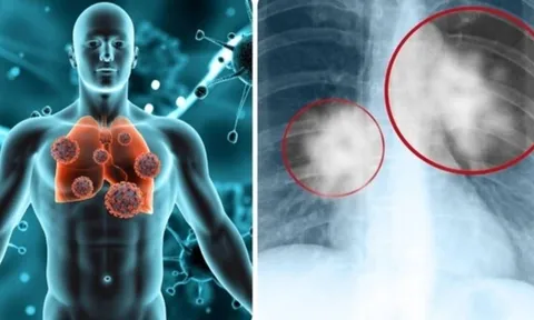 90% ca ung thư phổi ở nam giới Việt: Thói quen này là thủ phạm chính bạn cần biết!