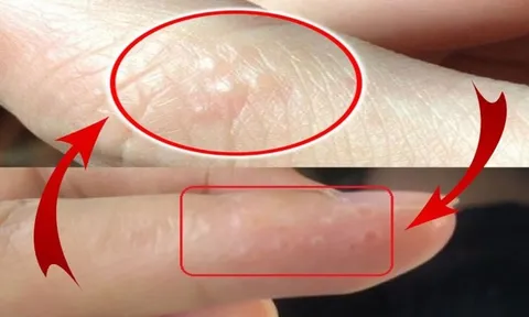 Tay  mọc mụn nước li ti có sao không?