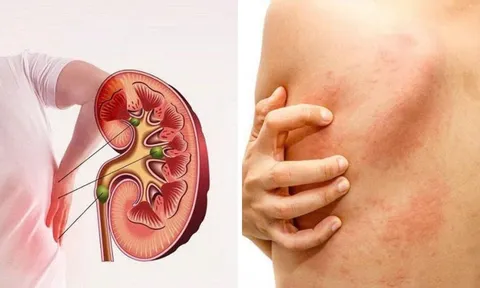 5 dấu hiệu suy thận giai đoạn đầu cần biết: Số 3 nhiều người bị nhưng phớt lờ