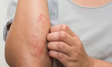 ５dấu hiệu cảnh báo bạn đang mắc bệnh thận giai đoạn nặng: Có 1 cũng nên đi khám sớm