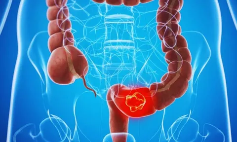 Người có bệnh này nguy cơ ung thư gần 100% sau 40 tuổi: Tuyệt Đối đừng chủ quan
