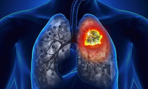 7 dấu hiệu cảnh báo ung thư phổi sớm: Đi khám ngay kẻo di căn xa