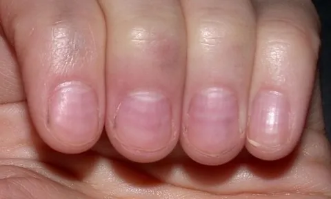 Nhìn móng tay bắt bệnh cực kỳ chính xác