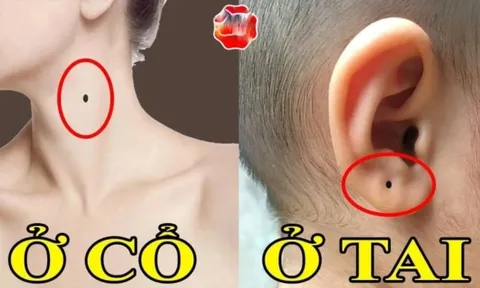 Những nốt ruồi Thần Tài 'đánh dấu', số 3 muốn nghèo cũng khó